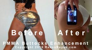 Booty Lift Before After Photos